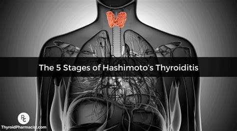 The 5 Stages Of Hashimotos Thyroiditis Dr Izabella Wentz