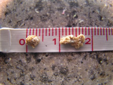 How Big Is A 4mm Kidney Stone