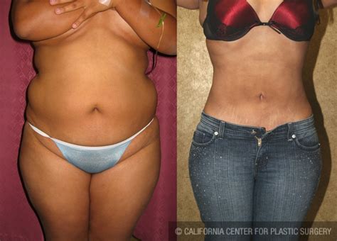 Patient Liposuction Abdomen Medium Before And After Photos