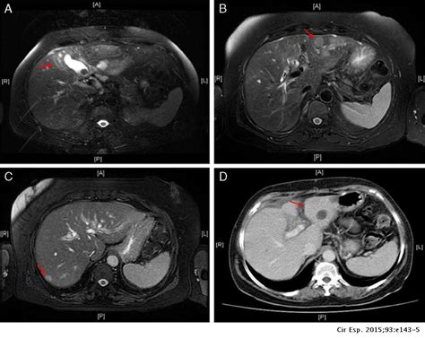 Tuberculosis Of The Gallbladder Vs Metastatic Vesicular Carcinoma A