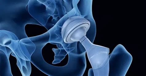 Top Hip Replacement Hospital In Hyderabad Best Orthopedic Hospitals