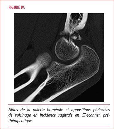 Lostéome ostéoïde intra articulaire du coude une pathologie rare