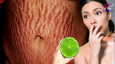 In 3 Days Remove Stretch Marks Completely World S Best Remedy For