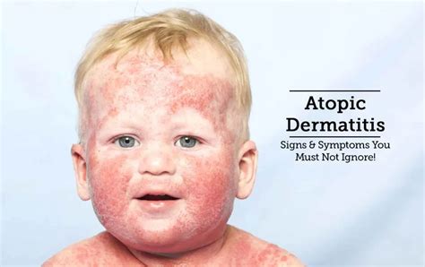 Atopic Dermatitis In Children Causes And Treatment