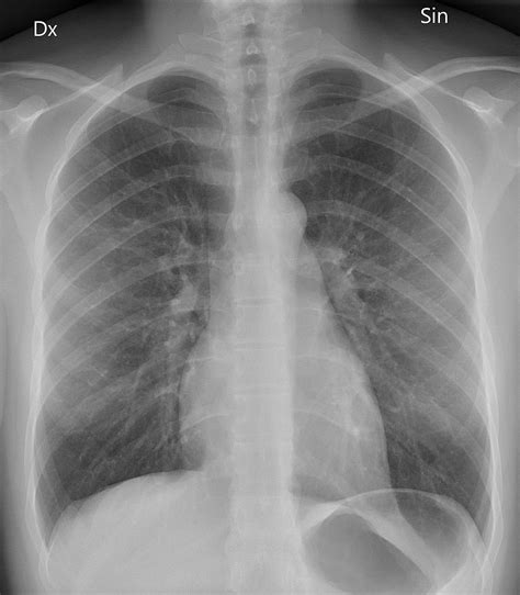 In fact every radiologst should be an expert in chest film reading. Chest radiograph - Wikipedia
