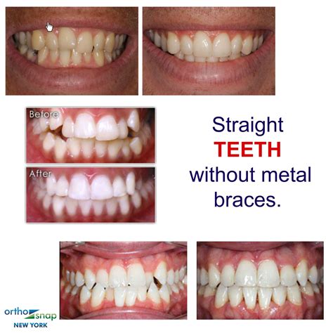 How To Have Straight Teeth Without Braces Just For Guide