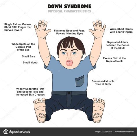 Syndrome Physical Characteristics Infographic Diagram Showing Affected