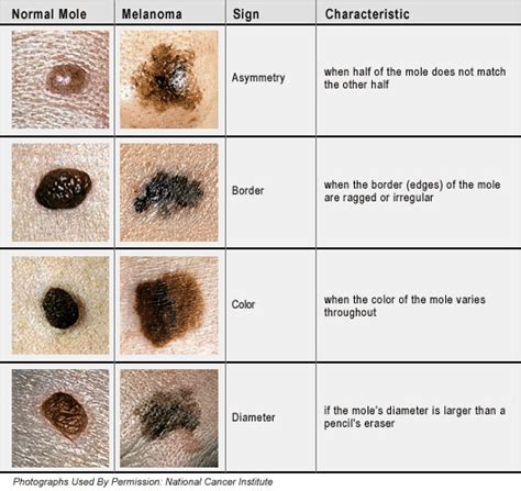 Telling Normal Moles From Melanoma Skin Cancer Mississippi State