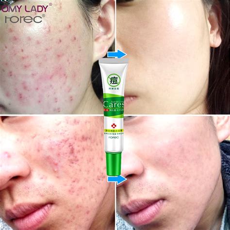 Buy Omy Lady Hanchan Acne Treatment Moisturizing Skin