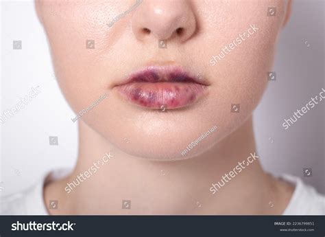Real Womens Bruised Lips After Lip Stock Photo 2236799851 Shutterstock