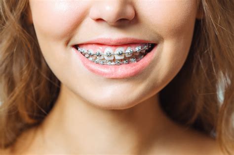 Orthodontic Braces Grand Dental Blue Mountains