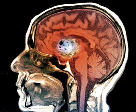 Astrocytoma Brain Cancer Photograph By Zephyrscience Photo Library
