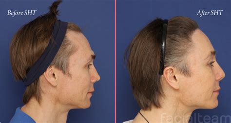 Simultaneous Hair Transplant Sht Vs Hairline Lowering Facialteam