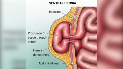 Umbilical Hernia Presentation