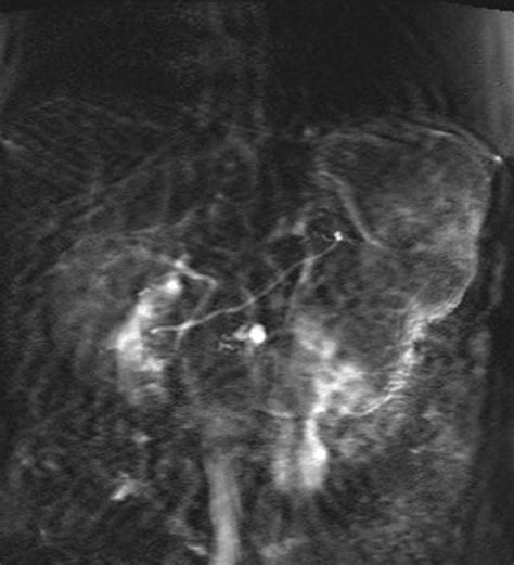 Pancreatic Divisum Body Mr Case Studies Ctisus Ct Scanning