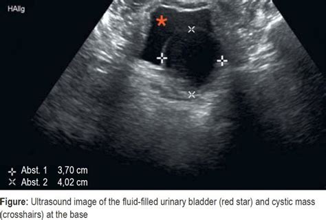 Unexplained Lower Abdominal Pain In Cystic Urinary Bladder Tumor 1311