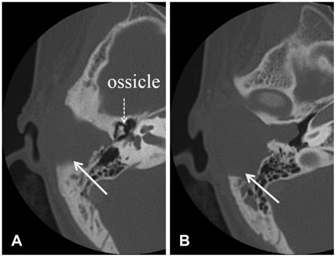 A Pre Operative Temporal Bone Ct Scans Show A Large Download