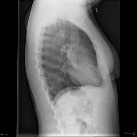 Image Gallery Lateral Chest X Ray