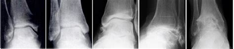 Stages Of Development Of Ankle Osteoarthritis A Zero No Changes
