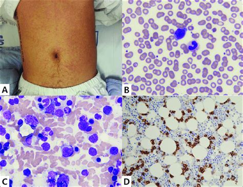 A Erythema Multiforme On The Trunk Showing Target Lesions B