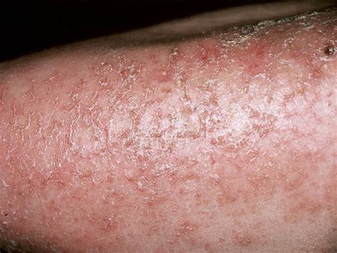 Asteatotic Eczema Eczema Craquele