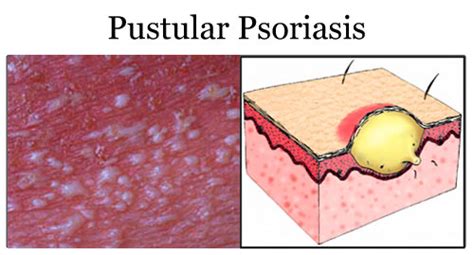Psoriasis Autoimmune Disease Of Skin Medchrome