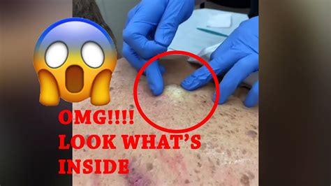 Pimple Popping Compilation Huge Cyst Explosion Satisfying Youtube