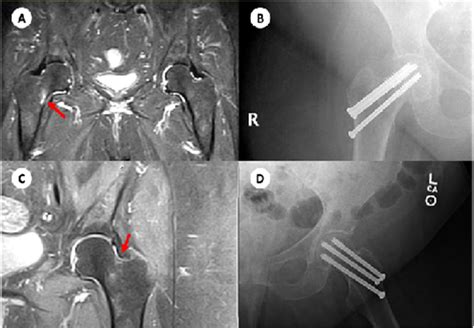 Early Diagnosis Of Femoral Neck Stress Fractures May Decrease Incidence