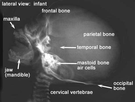 Medical Imaging Technology X Ray Anatomy Of The Infant Skull Lateral View
