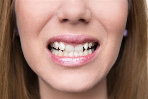 Why Fix Crooked Teeth Cosmetic Dentistry In Burlington Nc