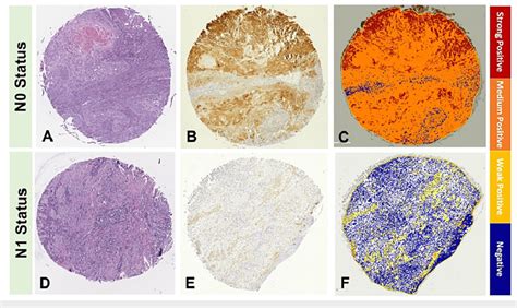 Cornulin Expression In Cutaneous Squamous Cell Carcinoma Tissue Samples