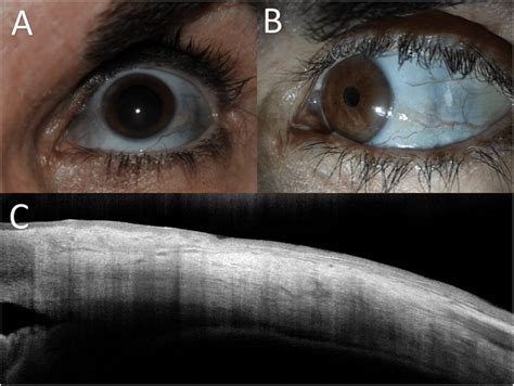 Minocycline Induced Scleral Pigmentation Image Of The Left Eye In