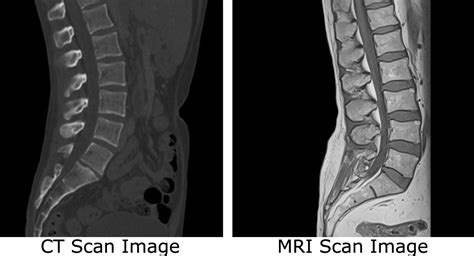 Mri scan is very noisy and you will be given earplugs or headphones. What's the Difference Between an MRI and a CT