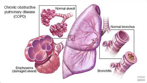 Chronic Obstructive Pulmonary Disease Risks Symptoms And Prevention Mayo Clinic News Network