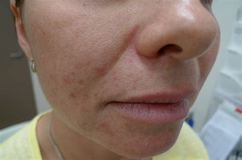 Face Rash Treatment Cream Doctor Heck