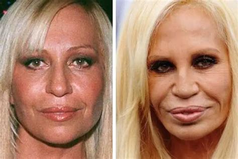 Donatella Versace Facelift Plastic Surgery Before And After Celebie