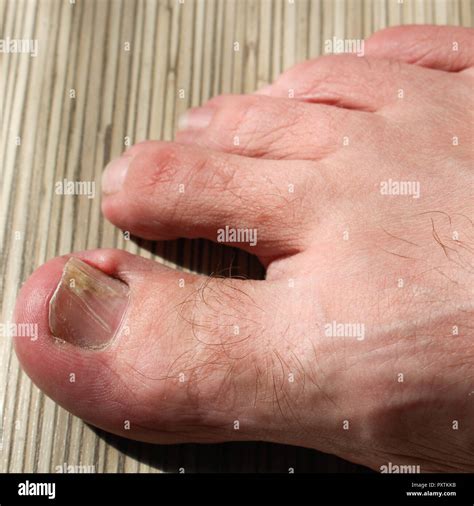 Big Toe Fracture Hi Res Stock Photography And Images Alamy