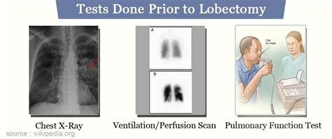 Lobectomy Surgical Procedure Types Procedures And Complications