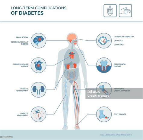 Longterm Complications Of Diabetes Stock Illustration Download Image