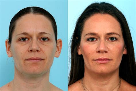 Five Techniques Of Injecting Dermal Fillers Houston Tx
