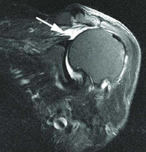 Massive Supraspinatus Tear Coronal Oblique Stir Image Demonstrating A