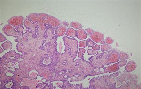 Both Glands And Papillary Structures Lined By Prostatic Epithelium H E