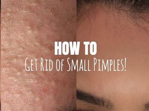 What Should You Do For Small Tiny Pimples On Face Pimples On Face