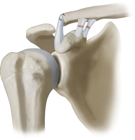 A Right Shoulder Acromioclavicular Joint Dislocation Treated With