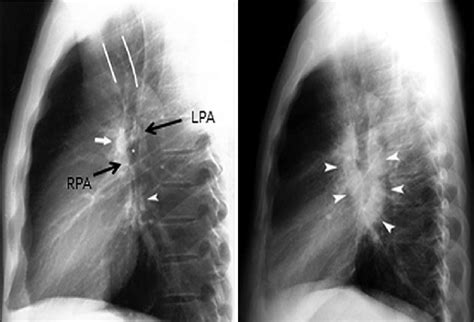 Normal Chest X Ray Lateral View