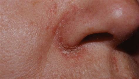Причины шелушащейся кожи вокруг носа рекомендации Lyekarstvo