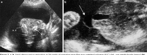 figure 1 from cephalopagus conjoined twins presented with encephalocele diagnostic role of