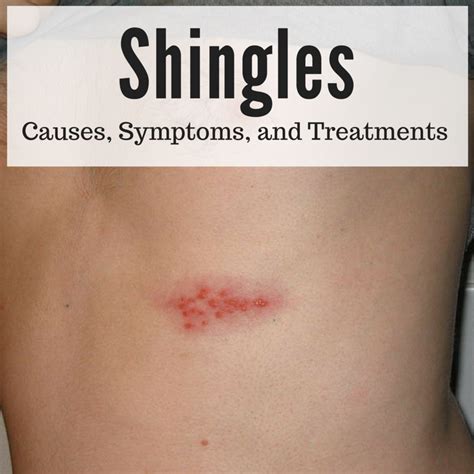 Shingles A Serious And Painful Disease Healdove