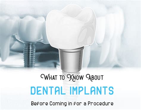 What To Know About Dental Implants Procedure
