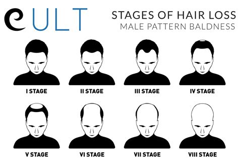 Stages Of Male Pattern Baldness